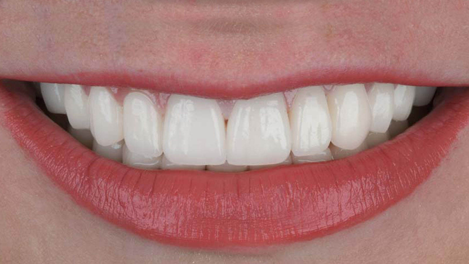 Smile Makeover - Lumos Dental Clinic - Dental Centre Turkey