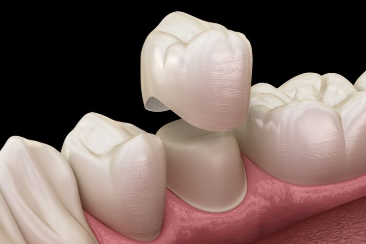 Dental Crowns in Turkey
